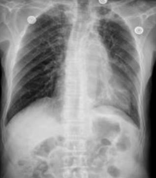 CASIA-CXR: An Open Chest X-ray Dataset with Benchmarks for Automatic Radiology Report Generation in French