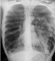 CASIA-CXR: An Open Chest X-ray Dataset with Benchmarks for Automatic Radiology Report Generation in French