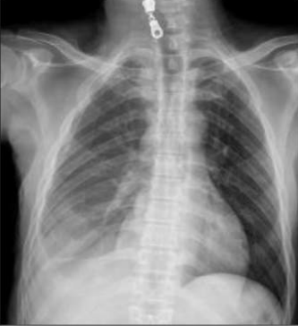 CASIA-CXR: An Open Chest X-ray Dataset with Benchmarks for Automatic Radiology Report Generation in French