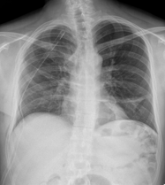 CASIA-CXR: An Open Chest X-ray Dataset with Benchmarks for Automatic Radiology Report Generation in French