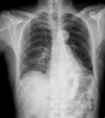 CASIA-CXR: An Open Chest X-ray Dataset with Benchmarks for Automatic Radiology Report Generation in French