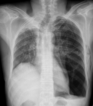 CASIA-CXR: An Open Chest X-ray Dataset with Benchmarks for Automatic Radiology Report Generation in French