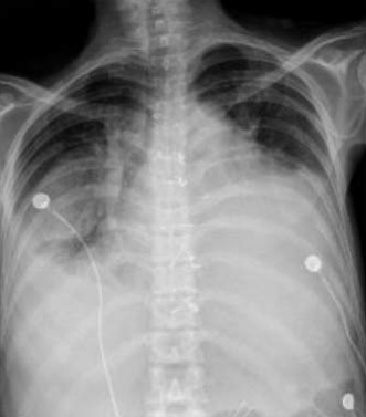 CASIA-CXR: An Open Chest X-ray Dataset with Benchmarks for Automatic Radiology Report Generation in French